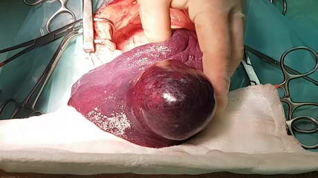 A Splenectomy