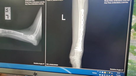 Radial Ulnar Fracture Repair in a Puppy